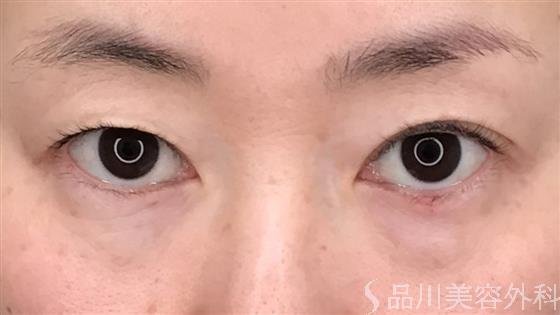 症例NO.56179のBEFORE写真