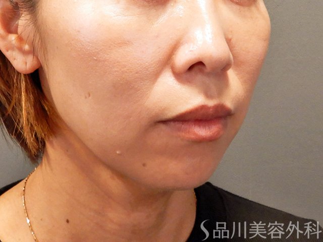 症例NO.68633のBEFORE写真