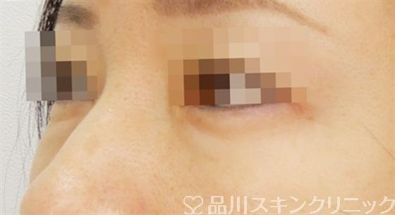 症例NO.50606のBEFORE写真