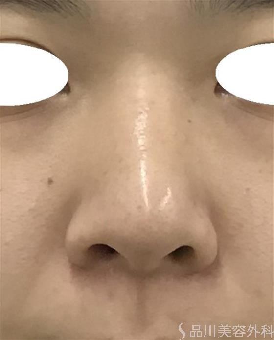 症例NO.50188のBEFORE写真