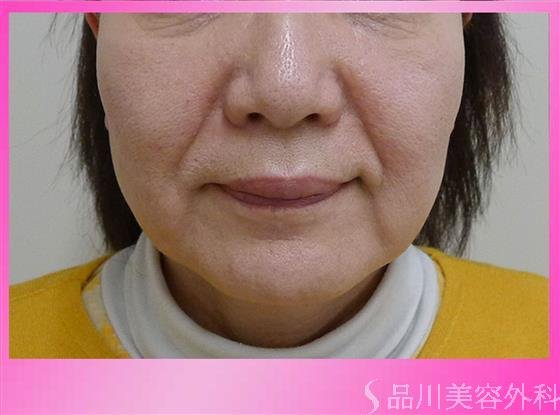 症例NO.40198のBEFORE写真