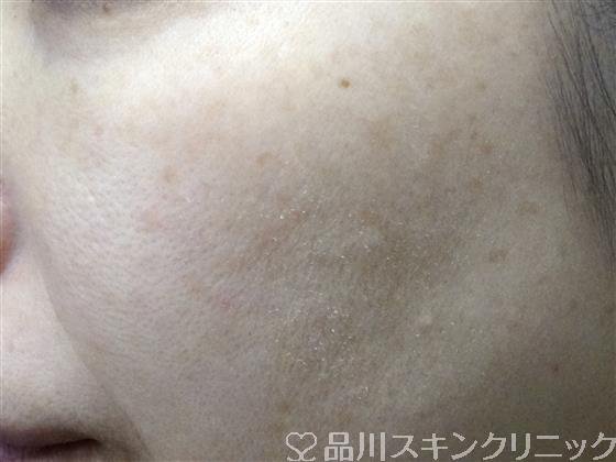 症例NO.32764のBEFORE写真