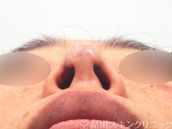 症例NO.54748のAFTER写真