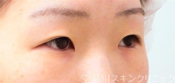 症例NO.53230のBEFORE写真