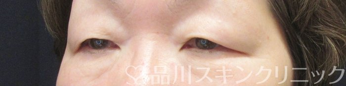 症例NO.68044のBEFORE写真