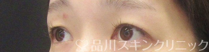 症例NO.62015のBEFORE写真