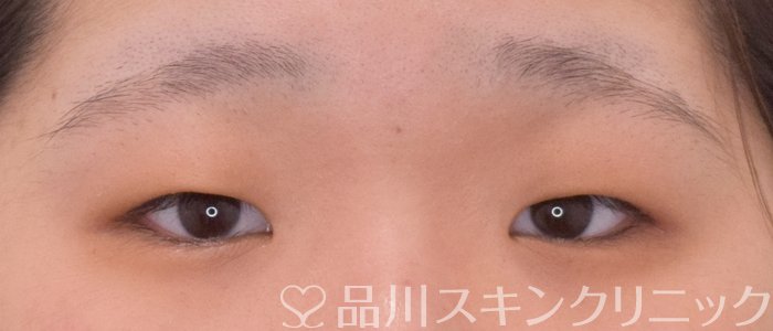 症例NO.63988のBEFORE写真