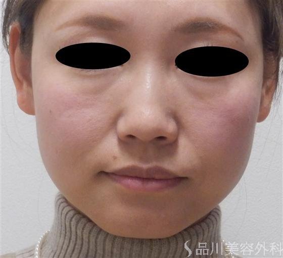 症例NO.15289のBEFORE写真