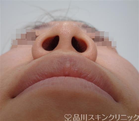 症例NO.48981のBEFORE写真