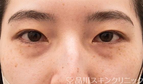 症例NO.61040のBEFORE写真