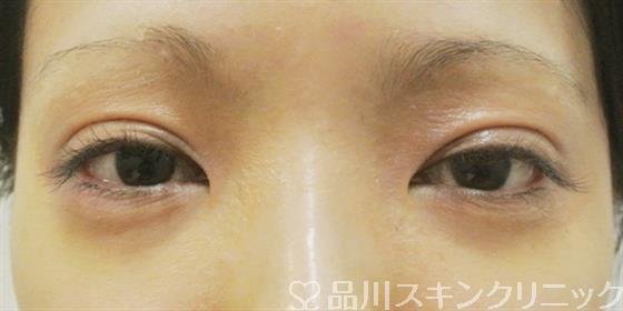 症例NO.40908のBEFORE写真