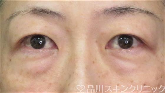 症例NO.59872のBEFORE写真