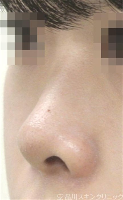 症例NO.30612のBEFORE写真