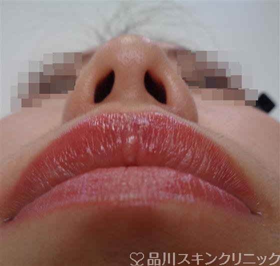 症例NO.48981のAFTER写真