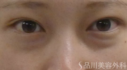 症例NO.62760のBEFORE写真