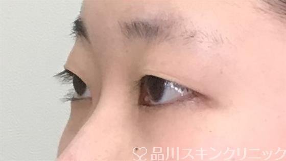 症例NO.57313のBEFORE写真