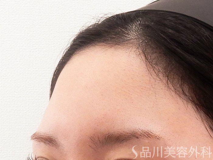 症例NO.62184のBEFORE写真