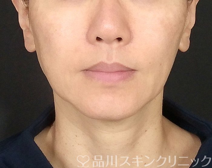 症例NO.62360のBEFORE写真