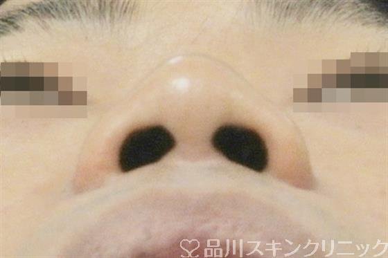 症例NO.38275のBEFORE写真