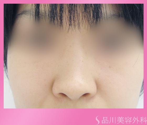 症例NO.1338のBEFORE写真