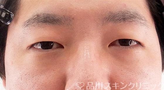 症例NO.58020のBEFORE写真