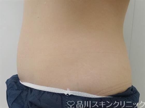 症例NO.30572のBEFORE写真