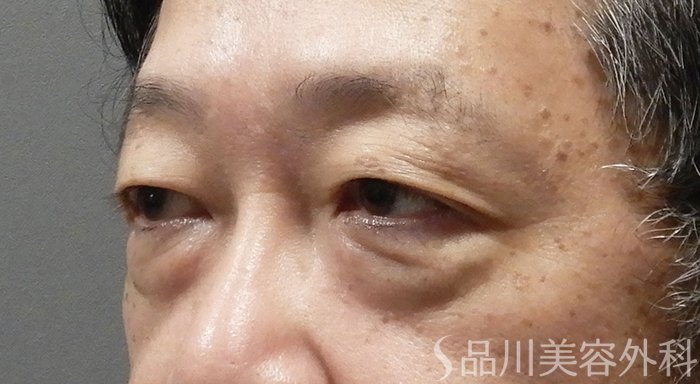 症例NO.66082のBEFORE写真