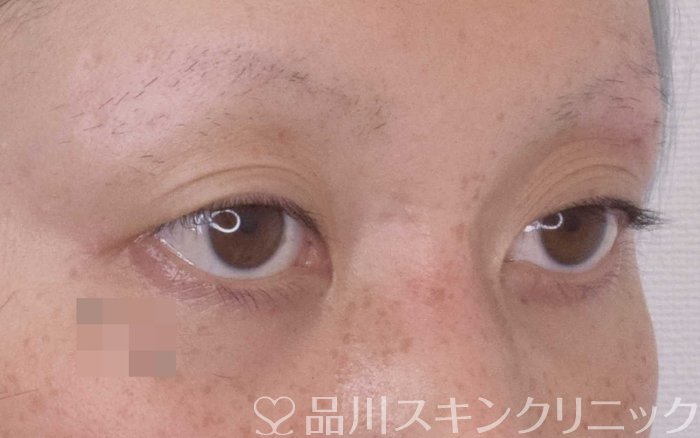 症例NO.66088のBEFORE写真