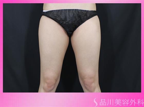 症例NO.51660のBEFORE写真