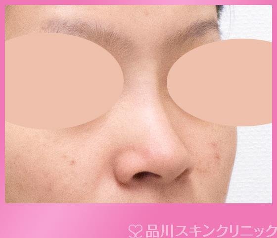 症例NO.26561のBEFORE写真