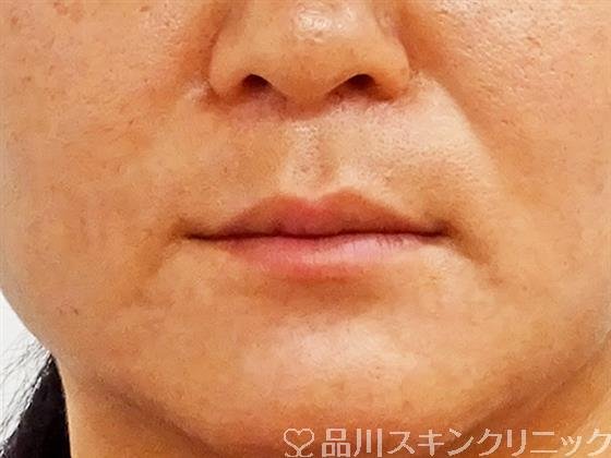 症例NO.49621のBEFORE写真