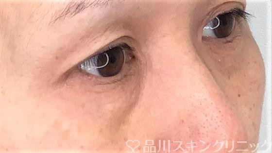 症例NO.60382のBEFORE写真