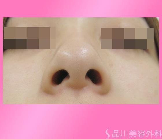 症例NO.3101のBEFORE写真