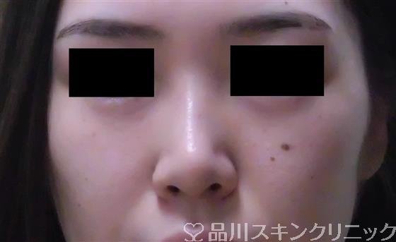 症例NO.35281のBEFORE写真