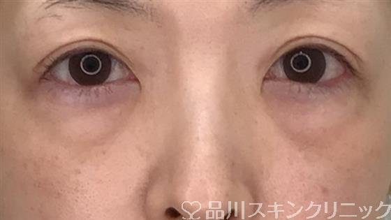 症例NO.55407のBEFORE写真