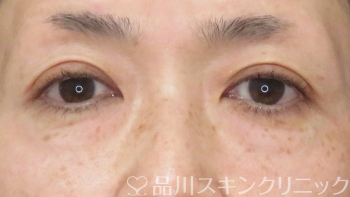 症例NO.68476のBEFORE写真