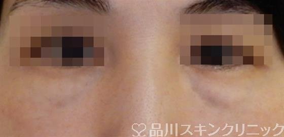 症例NO.51764のBEFORE写真