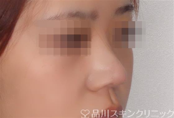 症例NO.50978のAFTER写真