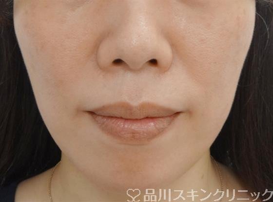 症例NO.43097のBEFORE写真