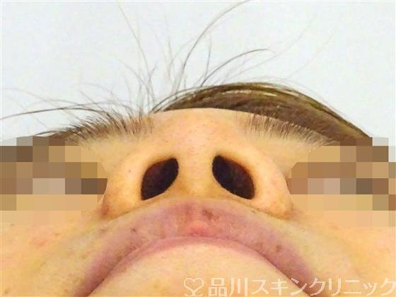 症例NO.47158のBEFORE写真