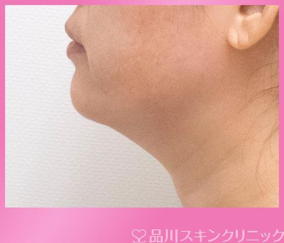 症例NO.27244のBEFORE写真