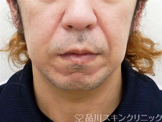 症例NO.54666のBEFORE写真