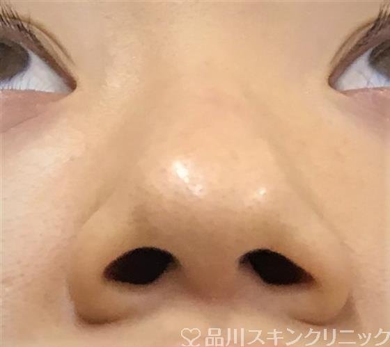 症例NO.52358のBEFORE写真