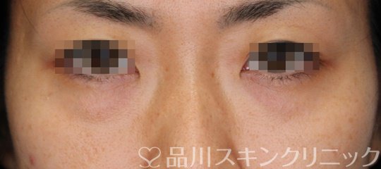 症例NO.64805のBEFORE写真