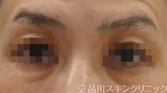 症例NO.56079のBEFORE写真