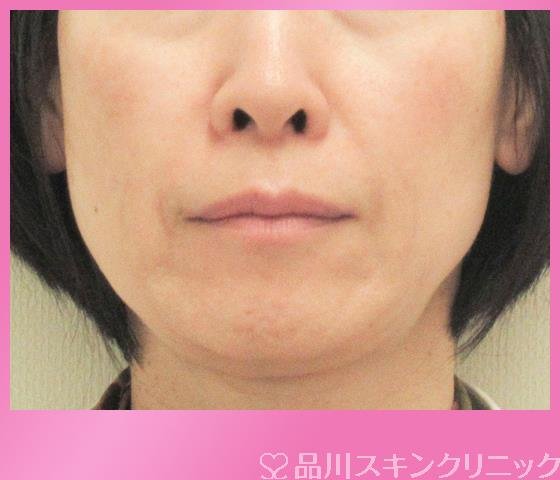 症例NO.27049のBEFORE写真