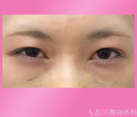 症例NO.25451のBEFORE写真