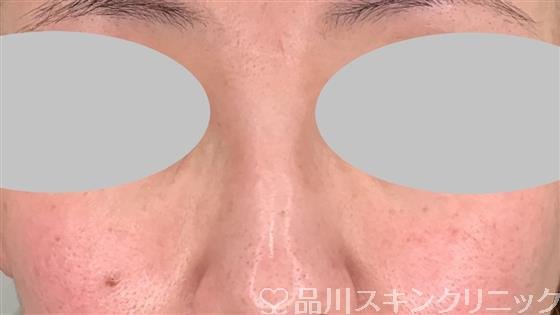 症例NO.55376のBEFORE写真