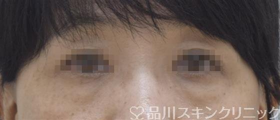 症例NO.52381のBEFORE写真