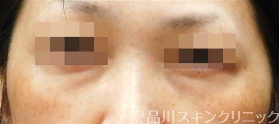 症例NO.57457のBEFORE写真